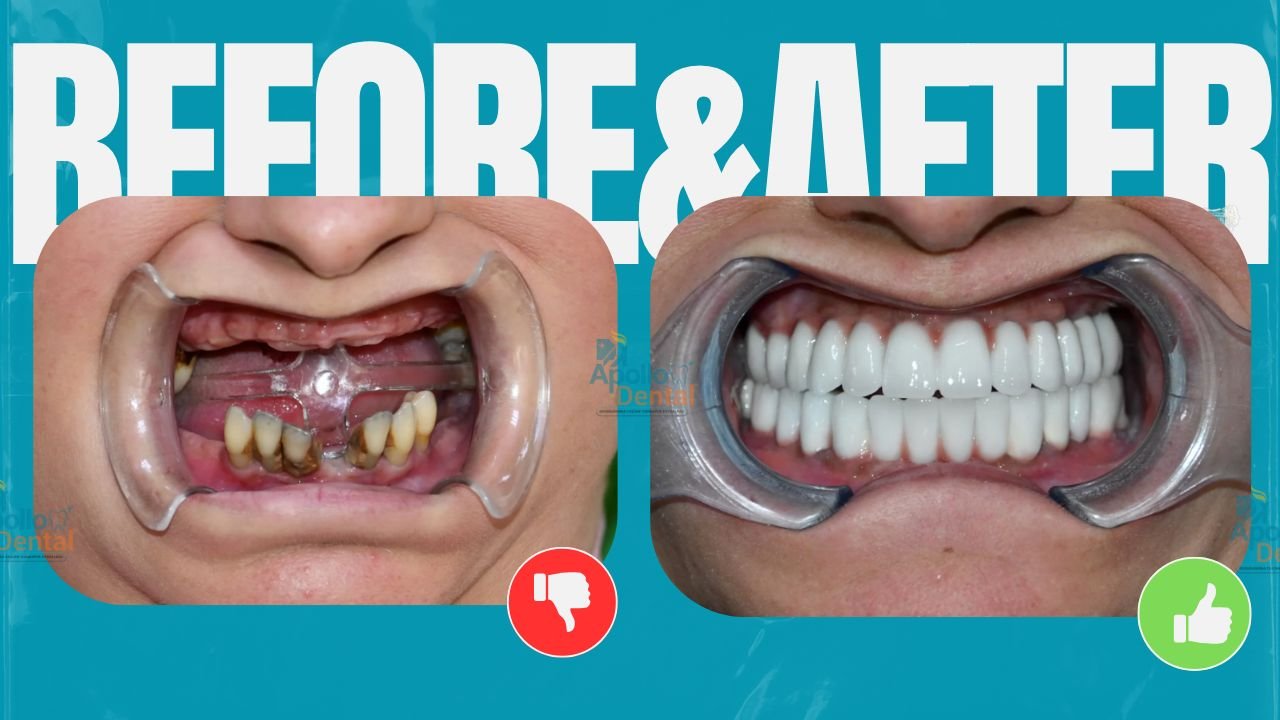 Apollo dental clinics Hyderabad (2)