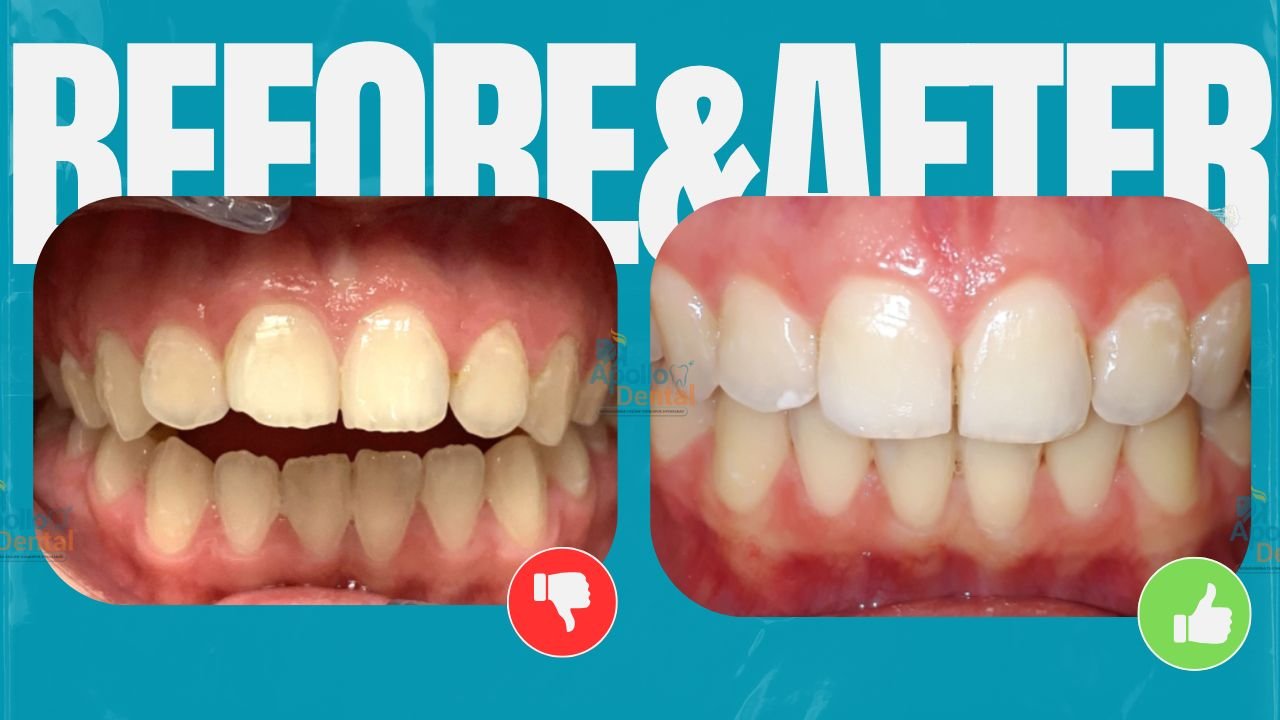 Apollo dental clinics Hyderabad (6)