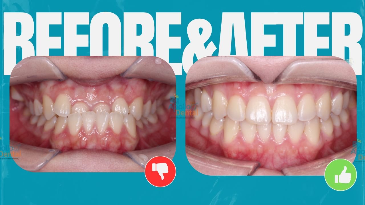 Apollo dental clinics Hyderabad (7)